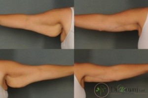 مزوتراپی بازو چه تاثیراتی دارد؟