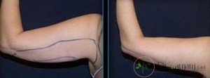 عوارض جانبی مزوتراپی بازو چیست؟