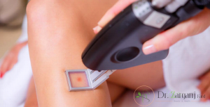از دیگر کاربردهای لیزر و لیزر درمانی می‌‌توان به رفع جاهای زخم اشاره کرد :