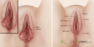 عمل زیبایی واژن لابیاپلاستی چه عوارضی دارد؟