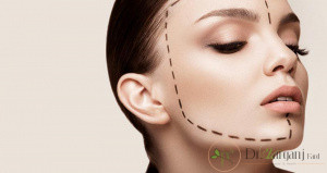 ژل ژوویدرم ولوما