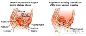  تزریق بوتاکس به واژن چه تأثیری در درمان واژینیسموس دارد؟