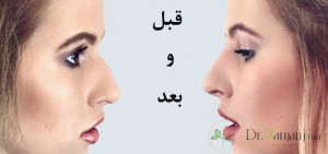 بهترین دکتر تزریق ژل بینی در تهران
