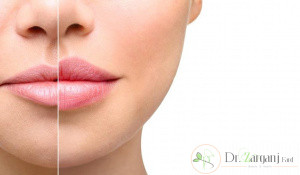 بعد از تزریق ژل لب چه نکاتی را باید رعایت کرد