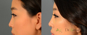 تزریق ژل برای گودی بینی