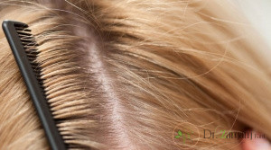 مزایای کربوکسی تراپی مو چه مواردی می باشد؟