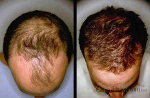 روش کربوکسی تراپی مو به چه صورت می باشد؟