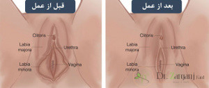عوامل تاثیر گذار بر عفونت بعد از عمل لابیاپلاستی