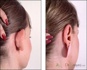جراحی زیبایی گوش در زنان به چه صورت است ؟