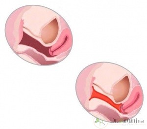 تنگ کردن عضله های کانال داخلی واژن