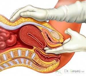 شل شدن دیواره های واژن ممکن است باعث بی اختیاری ادرار در زنان شود :