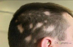 هیچ روشی برای درمان ریزش مو کشف نشده است