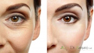 چین و چروک صورت به ویژه اطراف چشم: