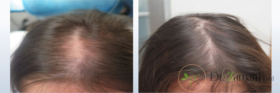 درمان ریزش مو به کمک روش مزونیدلینگ: