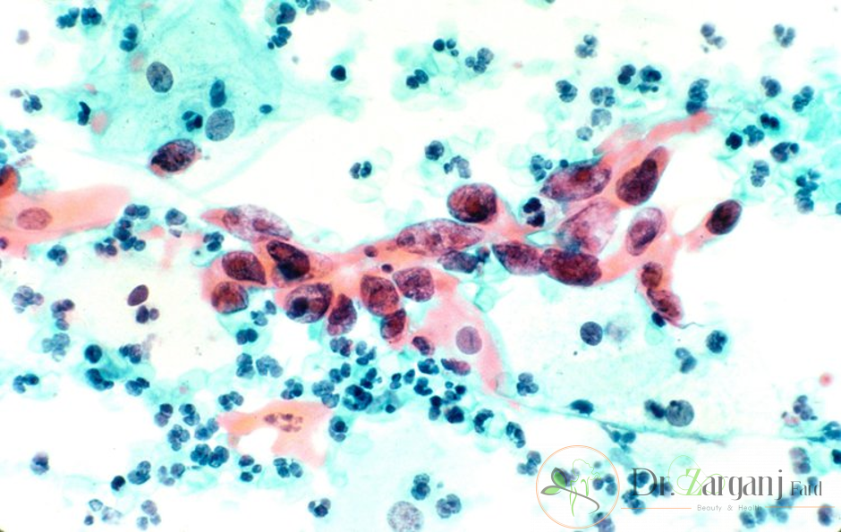 سلول های آدنوکارسینوم یا سرطان سلول سنگفرشی یا squamous cell cancer