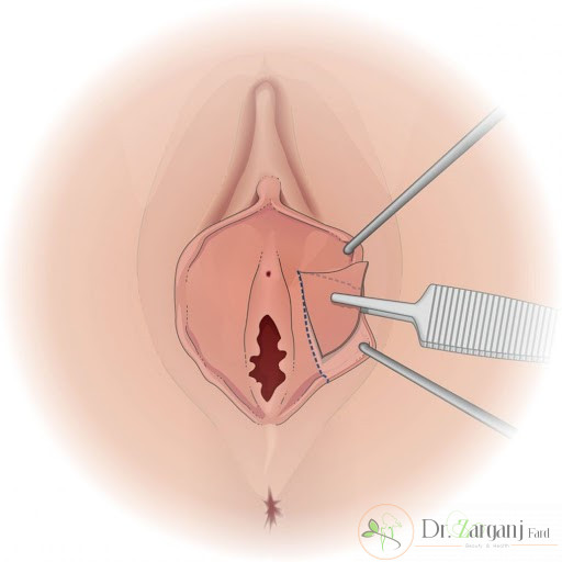 کلینیک مورد نظر برای جراحی لابیاپلاستی
