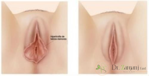 عمل جراحی زیبایی لابیاپلاستی یا زیبایی واژن