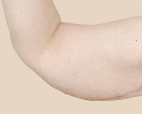 کربوکسی ترابی باعث درمان افتادگی پوست در نقاطی مانند بازو می شود