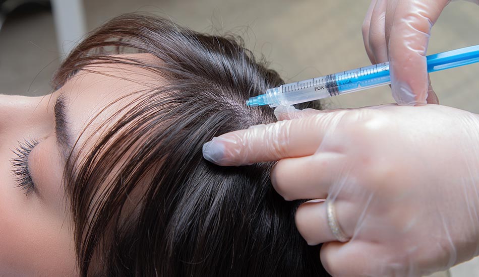 مزوتراپی مو و فیلر به ‌عنوان راهکارهای نوینی برای درمان ریزش مو شناخته می‌شوند