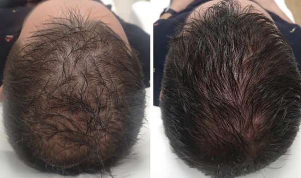 عوارض مزوتراپی مو چیست؟